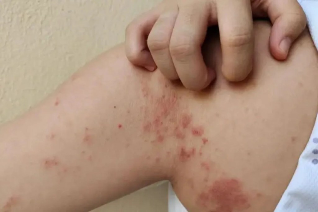 Ecuador registra 27 casos de lepra en 2025; autoridades sanitarias refuerzan la detección&nbsp;temprana