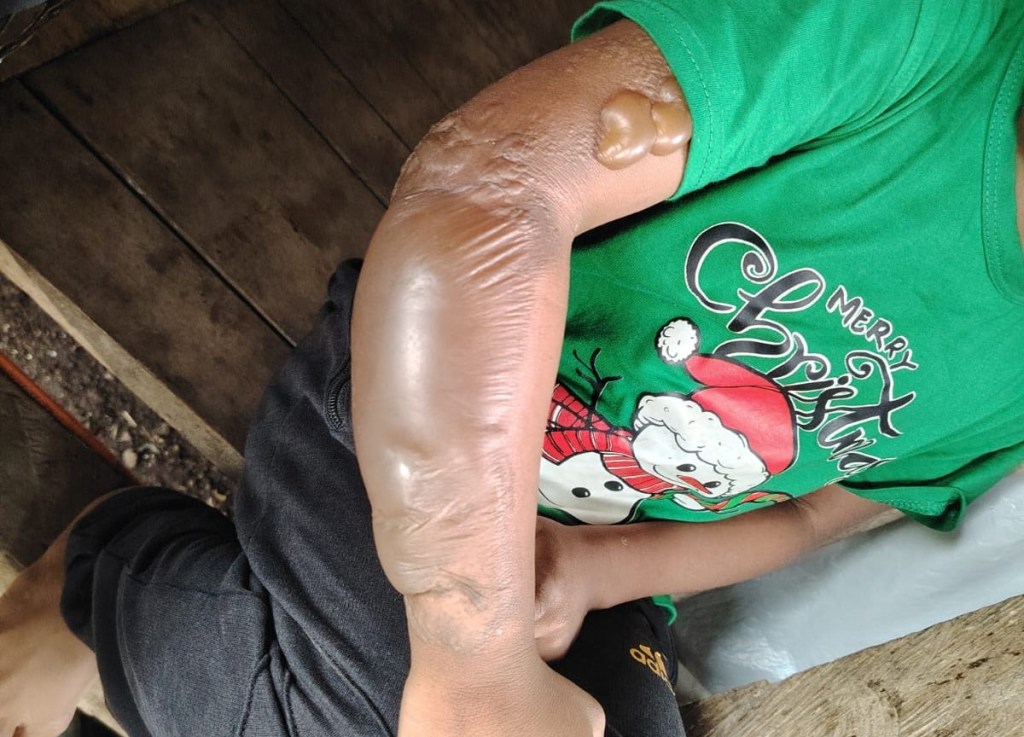 Niño sufre graves quemaduras tras accidente con gasolina y su familia pide ayuda